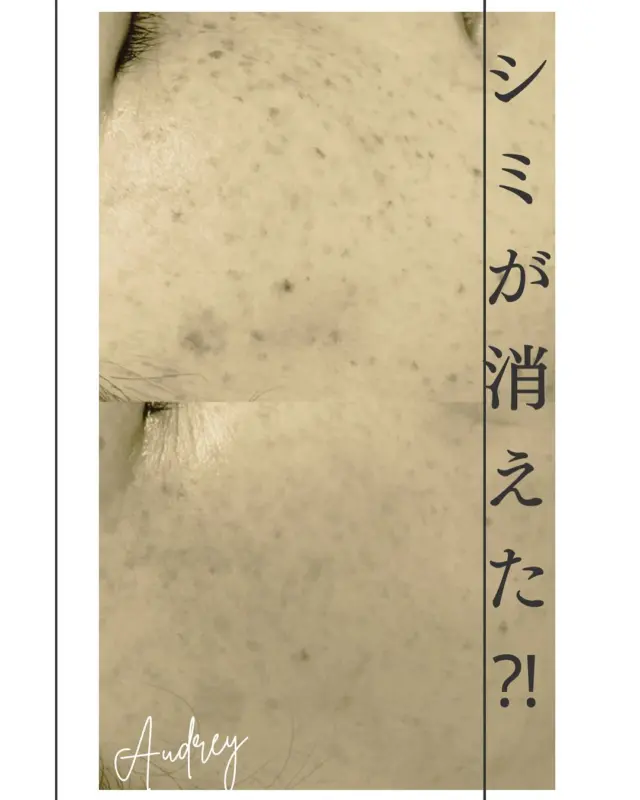 諦めないで大丈夫。

最新光美容は

長年悩んできたお肌悩み

シミ、ニキビ跡、たるみ、くすみのお悩みを
オーダーメイドのフィルターで
お一人お一人のお肌に合わせて解決していきます。

またシミ、たるみなど1つのお悩みだけでなく
お肌全体が明るく透明感がUPし肌質改善まで
叶っちゃいます。

繰り返しのケアで、ずっと悩んでいたものが
数ヶ月で見違えるまでに。

まずはお肌悩みご相談ください。

最新光美容のご予約は
DMまたは公式ラインから承っております。

———————————————

肌質改善される方続出
いちご鼻、黒ずみ角栓、毛穴の開き 
一度の施術でスッキリきれいに 
男性、学生様も大歓迎
福岡市中央区大濠公園、天神から10分 

#毛穴ケア専門サロン
#福岡毛穴ケア 
#シミ
#シミ解決
#光美容