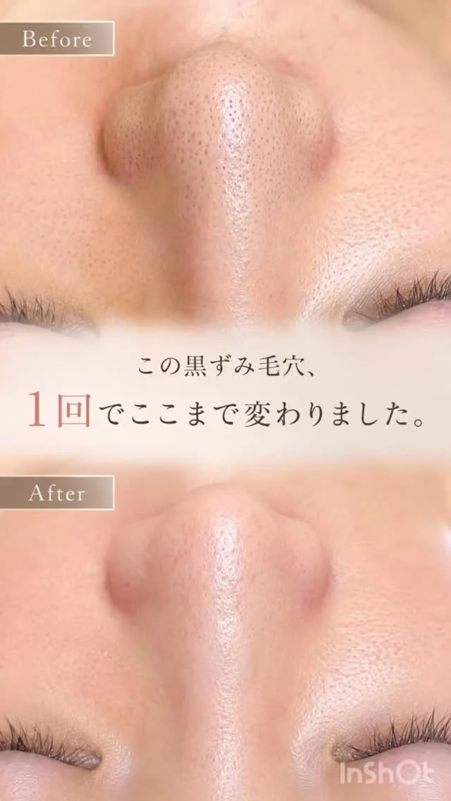 毛穴のお悩み、
「もう仕方ない」と諦めていませんか？🌿

Audreyでは、一人ひとりのお肌の状態を丁寧に見極めながら、その方に合ったケアをご提案しています。

✔ 黒ずみ毛穴
✔ 毛穴の開き
✔ いちご鼻
✔ ファンデーションでも隠れない毛穴

そんなお悩みも、お気軽にご相談ください。

落ち着いたプライベート空間で、心までリラックスしながらお過ごしいただけます🕊️

「自分の肌に自信を持てるようになった」
そんなお声をいただけることが、私たちの何よりの喜びです。

毛穴のお悩み、
お気軽にご相談ください。

あなたに合ったケアをご提案いたします✨

ご予約はプロフィールのURLからお待ちしております🤍

#福岡エステ
#毛穴専門サロン 
#毛穴ケア 
#黒ずみ毛穴 
#いちご鼻
いちご鼻