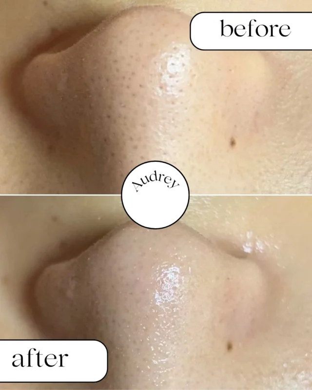 ✨30代女性 毛穴before  after✨

「毛穴はもう変わらない…」
そう思っていませんか？

実は毛穴は、一度のお手入れだけではなく、
サロンケアと毎日のホームケアを続けることで少しずつ変化していきます。

今回のお客様も、
毛穴のお悩みでご来店。

今では2か月に一度のメンテナンス、しばらくお手入れがあいてもツルツルな毛穴をキープされています✨

年齢を理由にあきらめる必要はありません。

お肌は、正しいケアを続ければ
いくつになっても応えてくれます。

毛穴のお悩みは、一人で抱え込まずお気軽にご相談ください😊

🌿ご予約は
・公式LINE
・ホットペッパービューティー
・InstagramのDM
より承っております。

＼ご新規様限定／
人気No.1✨
毛穴フルコース
通常14,000円 → 初回9,800円

皆さまのご来店を心よりお待ちしております💐

#毛穴専門サロン 
#毛穴ケア 
#黒ずみ毛穴 
#いちご鼻 
#毛穴